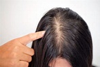 【頭頂稀疏】了解原因+4款適合頭頂稀疏髮型| Perfect Medical