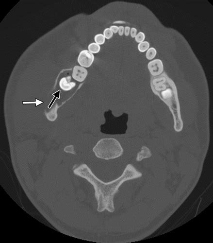 Dentigerous Cyst