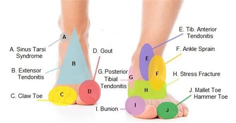 Foot Pain Chart Foot Pain Diagnosis For Upon