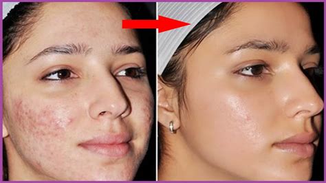 How To Get Fair And Clear Skin At Home Crystal Clear Spotless Skin
