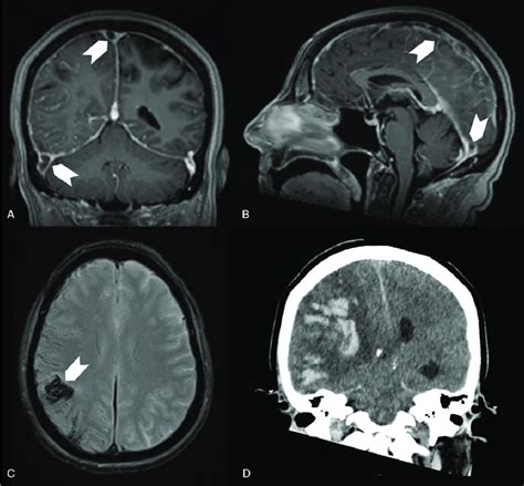 Patient Case 1 Cerebral Imaging Showing Cerebral Venous Thrombosis
