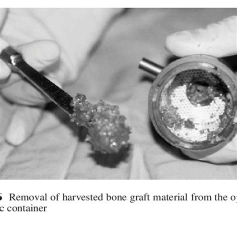 Four Different Cutting Tips Investigated For Cancellous Bone Graft
