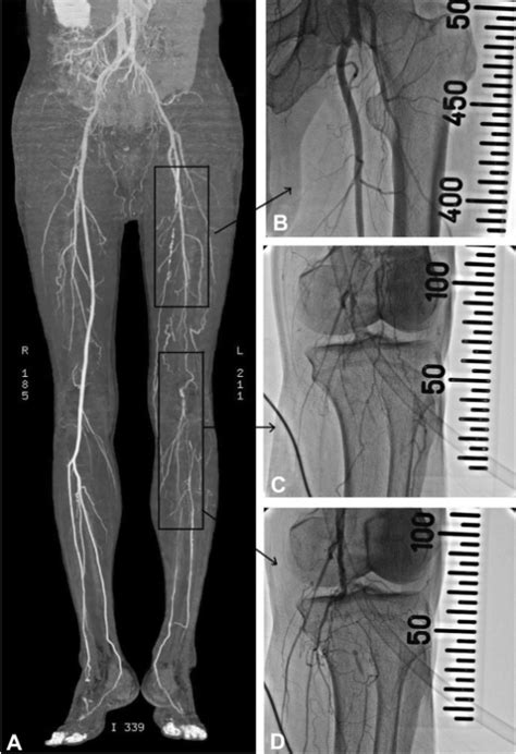 Computed Tomography And Angioplasty Of The Lower Extrem Open I