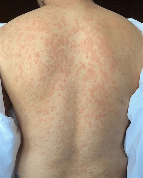 The Secondary Eruption In Pityriasis Rosea Showing The Christmas Tree