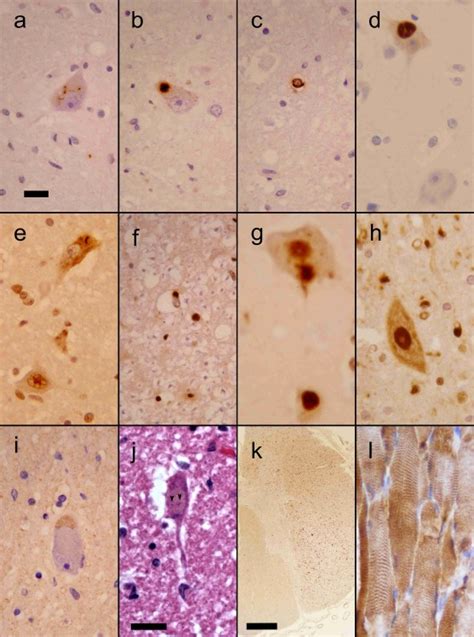 Immunohistochemistry Of Sporadic Amyotrophic Lateral Sclerosis Sals
