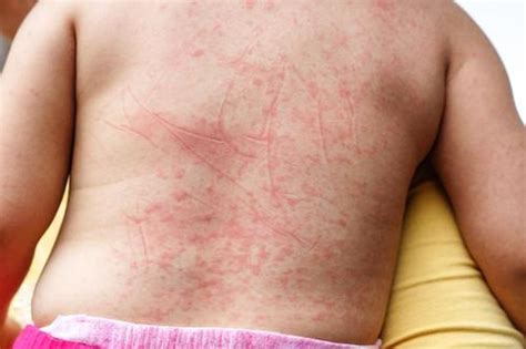 Scarlet Fever Is Making A Comeback Here Are The Warning Signs