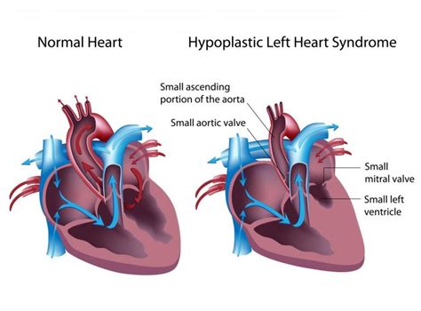 Hypoplastic Left Heart Syndrome Fetal Health Foundation