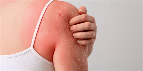Sunburn Treatment And Prevention