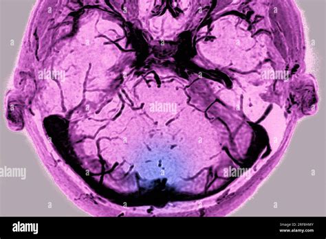 Thrombosis Of The Cerebral Venous Sinuses Of The Dura Mater Visualized