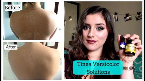 Tinea Versicolor Solutions Tnbeauty94 Youtube