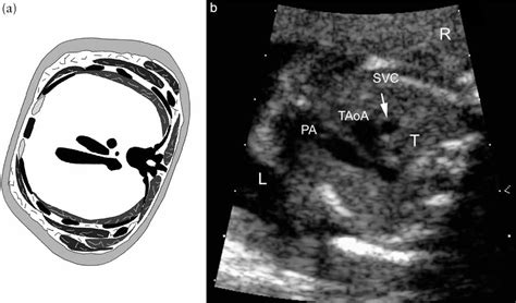 The Role Of The Three Vessels And Trachea View 3vt In The Diagnosis