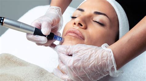 Microneedling Treatment Faqs Your Comprehensive Guide Oceanside