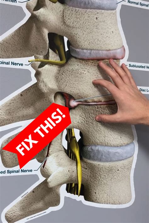 How To Fix A Bulging Disc In Your Lower Back Relief In Seconds
