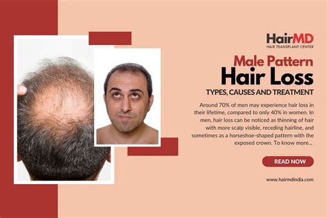 Male Pattern Baldness A Complete Guide
