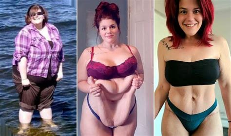 minnesota woman loses 196lbs and spends 13 000 to remove loose skin english