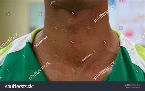 Huge Anterior Neck Swelling Left Thyroid Stock Photo 1103831063