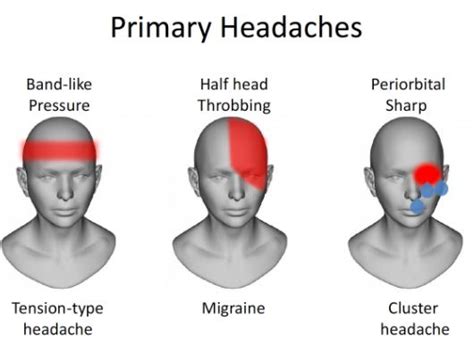 How Tmj Headaches Can Mislead Your Search For Headache Relief