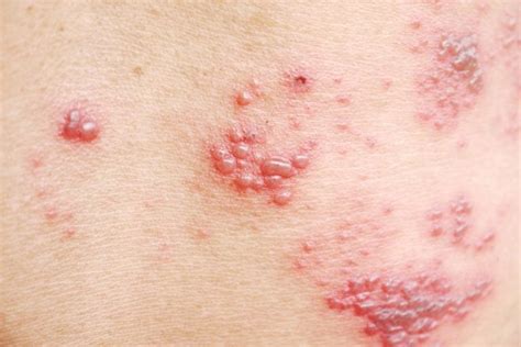 What Are Shingles A Closer Look At The Reality Of Shingles The Healthy