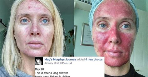 This Woman S Graphic Selfies Show Exactly The Danger Tanning Can Do To Your Skin In