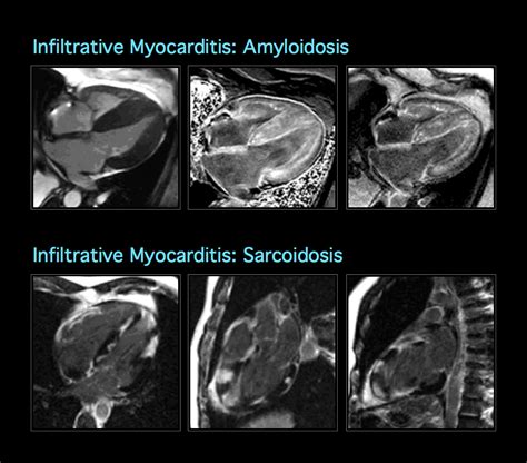 Mri Blog Imagery Of Cardiac Pathology