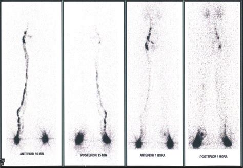 Lymphoscintigraphy Of Case 1 • Time To Appearance Of Inguinal Lymph