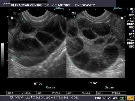Wk 4 L 2 Pic 3 Theca Lutein Cysts Tlc Ovarian Hyperstimulation