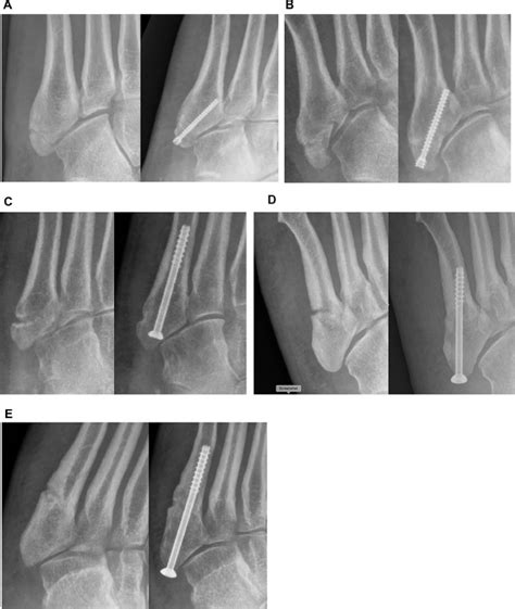 The Use Of Percutaneous Screw Fixation Without Fracture Site