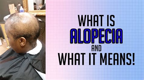 Suffering From Hairloss What Is Alopecia And What It Means Youtube
