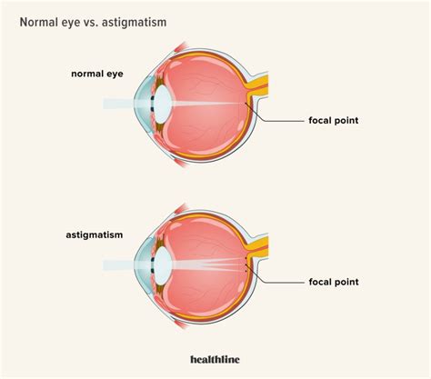 Can Astigmatism Be Fixed With Glasses