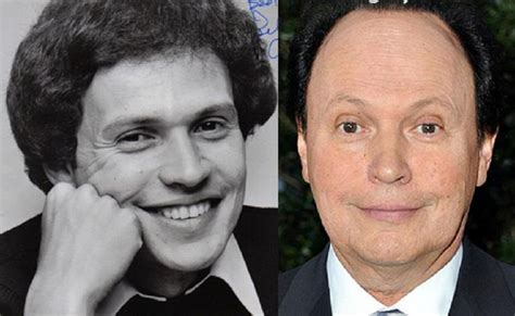 Celebrity Billy Crystal Bad Plastic Surgery Plastic Surgery Before