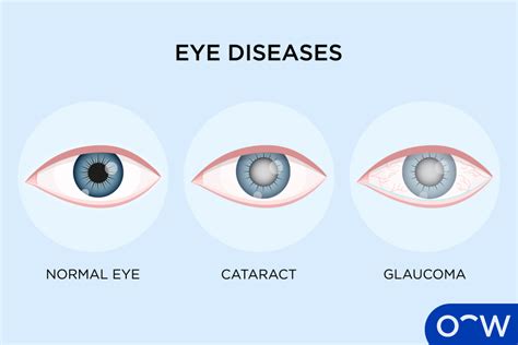 9 Ways To Detect Eye Disease