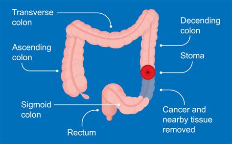 How Is Colon Cancer Is Detected Surgical Options