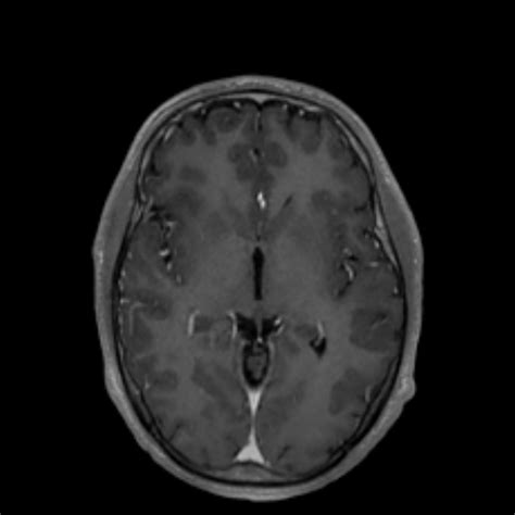 Multinodular And Vacuolating Neuronal Tumor Image
