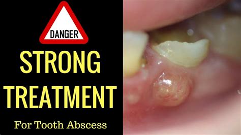 Cure Tooth Abscess Naturally In Record Time With This 1 Basic Technique