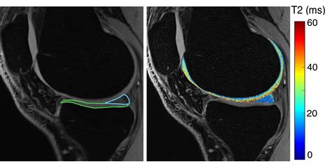 Five Minute Knee Mri For Simultaneous Morphometry And T2 Relaxometry