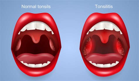 New Guidelines For Childrens Tonsillectomies Childrens And Teens