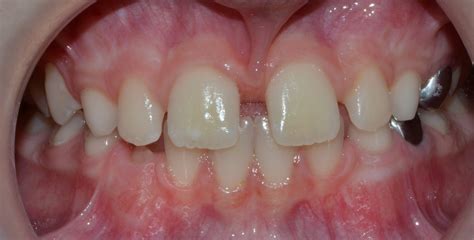 Cirugía – Clínica Dental Infantil Aguirrezabal