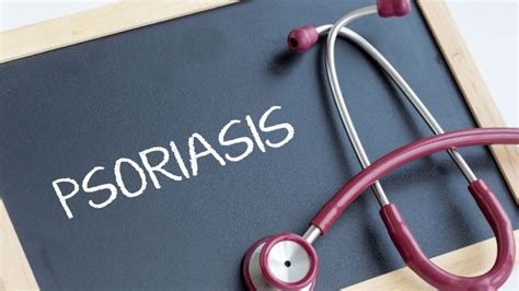 Psoriasis Kulit Kepala Simptom Punca Dan 14 Cara Merawat