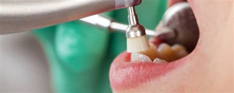 Curetaje Dental Qué Es Y Cuándo Debe Realizarse Clínica Dental