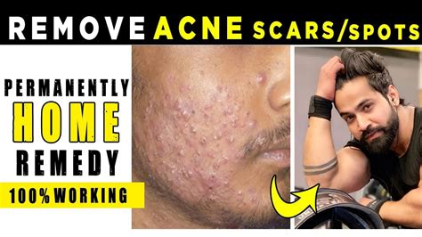 How To Remove Acne Scarsspots At Homehome Remedy For Acne Scars