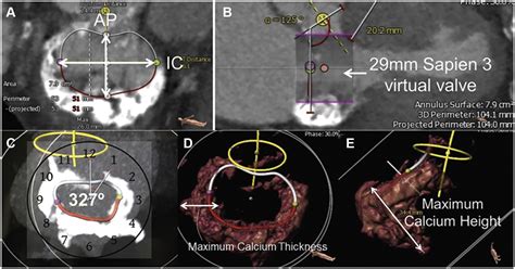 Ultrasonic Emulsification Of Severe Mitral Annular Calcification During