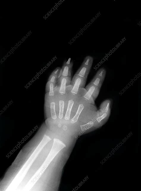 Babys Hand X Ray Stock Image P1160845 Science Photo Library