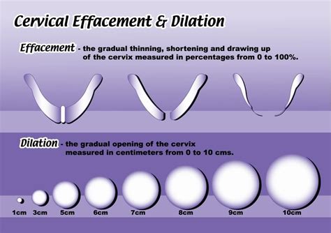 pic diagram of dilation and cervical effecement