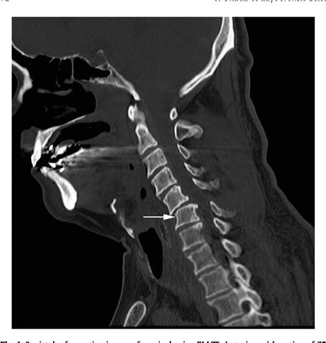 Figure 1 From A Case Of Fatal Cervical Discoligamentous Hyperextension