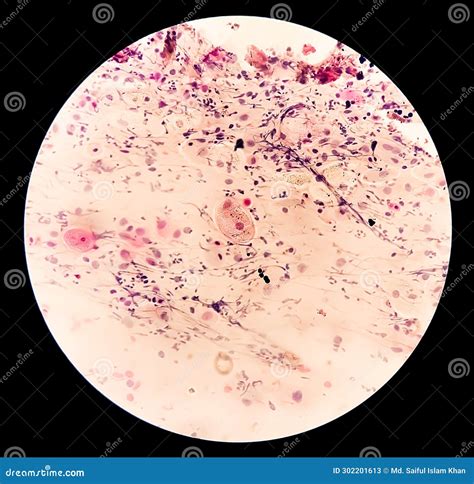 Photomicrograph Of Paps Smear Inflammatory Smear With Vaginal