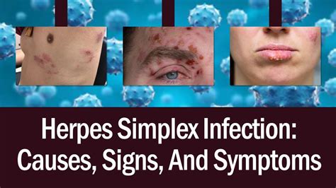 Herpes Symptoms Causes Signs Diagnosis Cure Hot Sex Picture