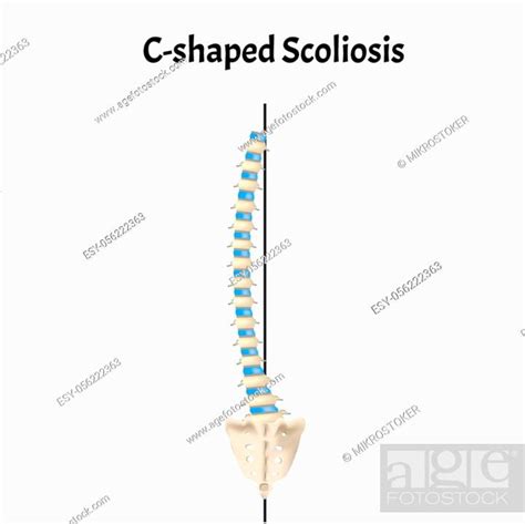 C Shaped Scoliosis Dextroscoliosis Levoscoliosis Spinal Curvature