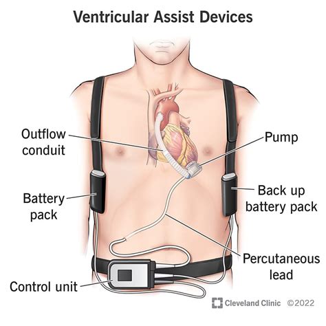 Aortic Valve Procedures At The Time Of Ventricular Assist Device My