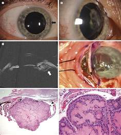 Age Related Hyperplasia Of The Nonpigmented Ciliary Body Epithelium