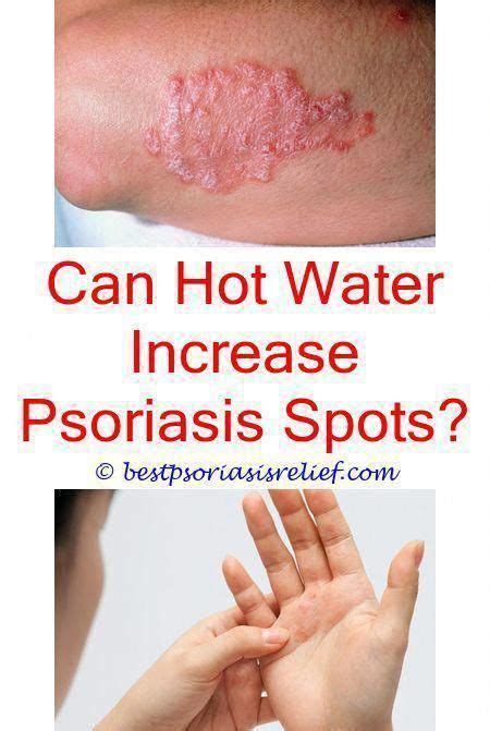 Colloidal Silver For Guttate Psoriasis